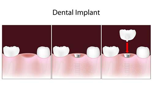 Dental Implants in North Miami