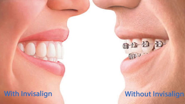 North Miami Invisalign