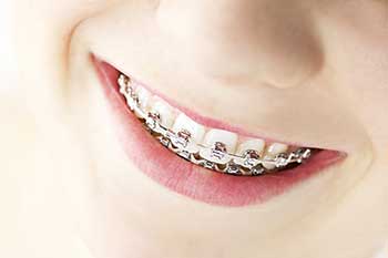 Dental Braces in Savannah