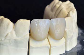 Dental Crowns in Savannah