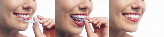 Invisalign in Savannah