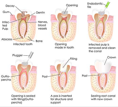 Root Canal in Savannah